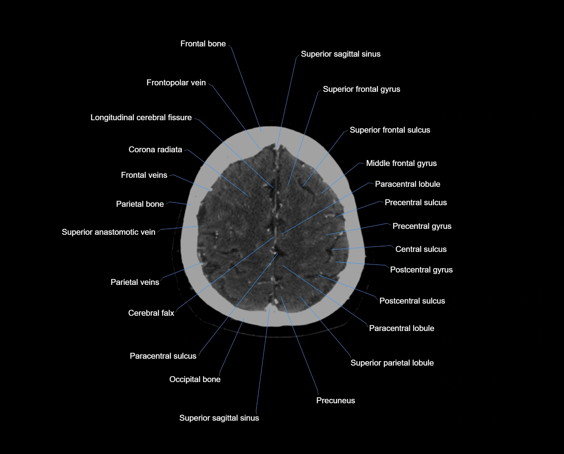 CT scan brain axial labelled cross sectional anatomy image-img-000058.webp